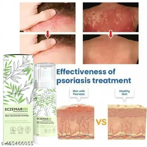 Eczemaron for Ringworm, itching, Eczema & Fungal Infection Anti Fungal Cream | (pack of 1)