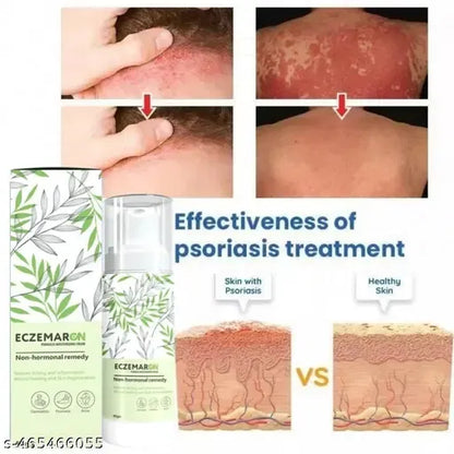 Eczemaron for Ringworm, itching, Eczema & Fungal Infection Anti Fungal Cream | (pack of 1)